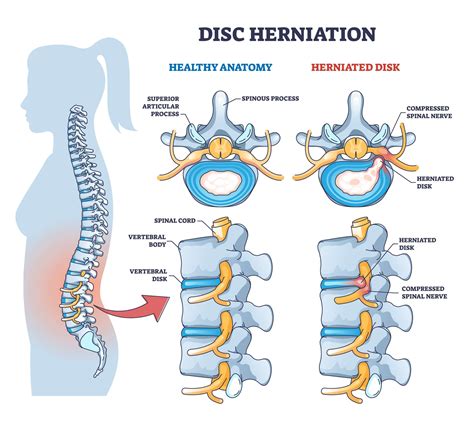 Relieving Herniated Disk Pain