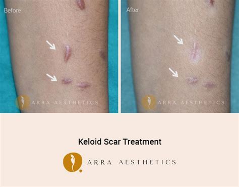 Remove Keloid Scar