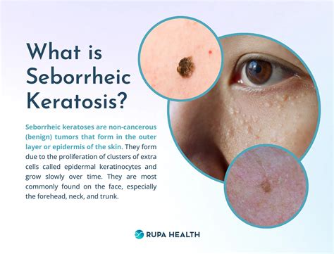 Remove Seborrheic Keratosis