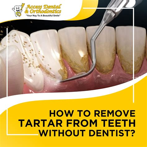 Remove Tartar From Teeth