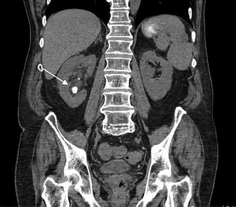 Renal Ct Scan