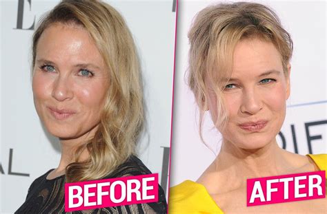 Renee Zellweger Face Surgery