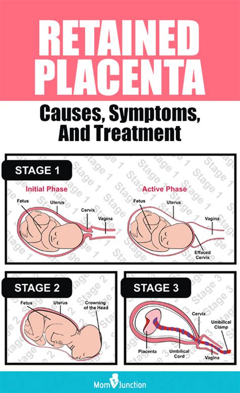 Retained Placenta Symptoms