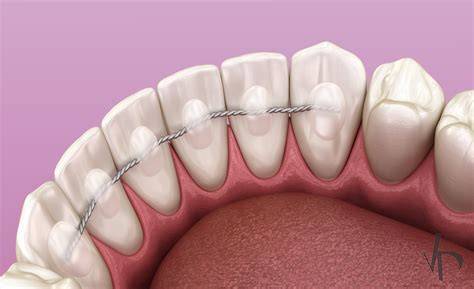 Retainer After Braces