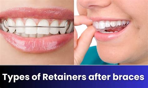 Retainers After Braces