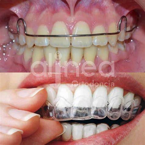 Retenedores De Dientes
