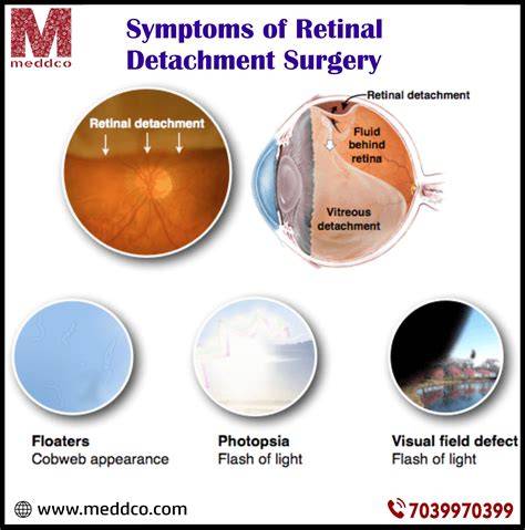 Retinal Detachment Symptoms