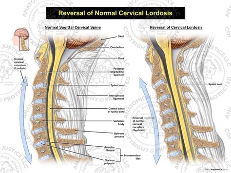 Reverse Lordosis Of The Neck