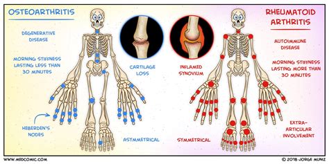 Rheumatoid Arthritis Vs Osteoarthritis