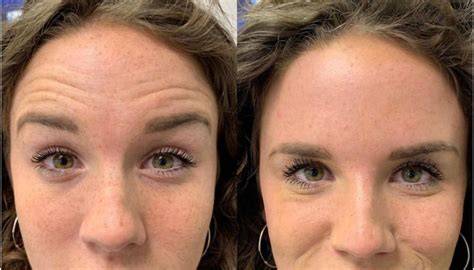 Rid Of Forehead Lines