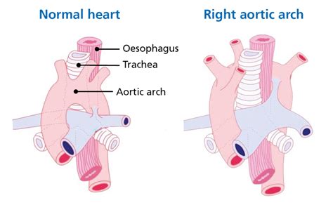 Right Aortic Arch