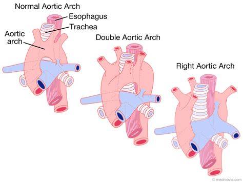 Right Sided Aortic Arch