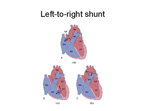Right To Left Shunt