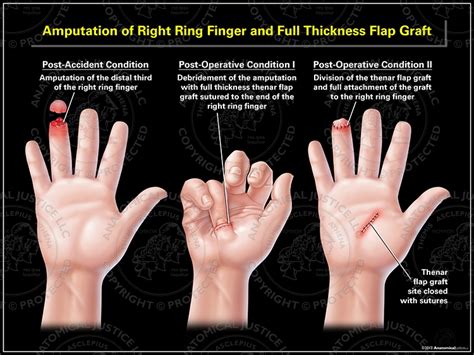 Ring Finger Amputation