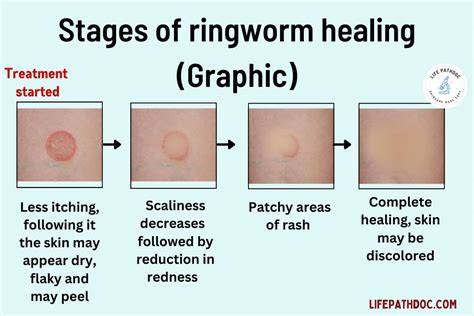 Ringworm Healing Stages