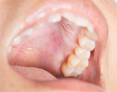 Roof Of Mouth White