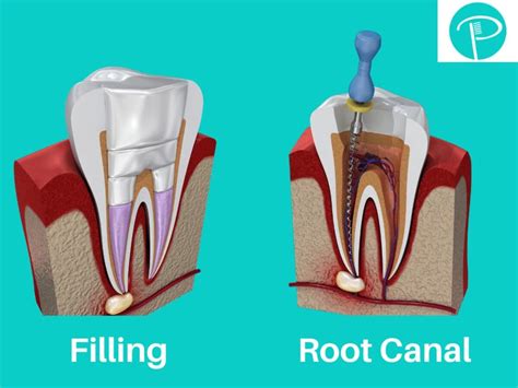 Root Canal After Care