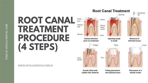 Root Canal Process