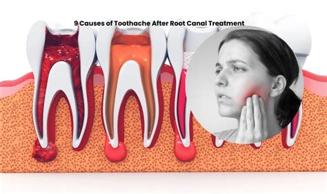 Root Canal Toothache Pain