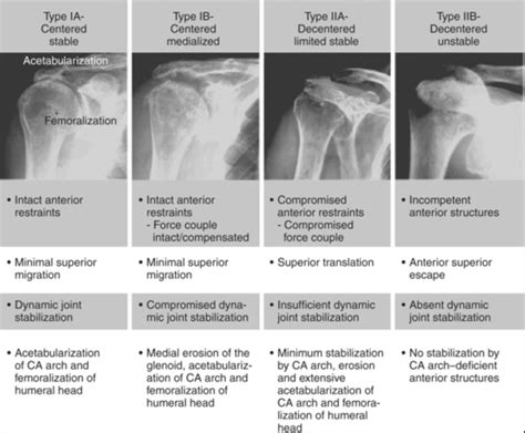Rotator Cuff Arthropathy
