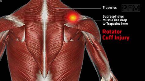 Rotator Cuff Pain
