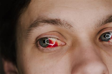Ruptured Blood Vessel In Eye
