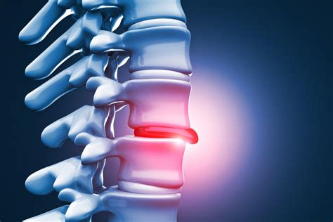 Ruptured Disk Neck