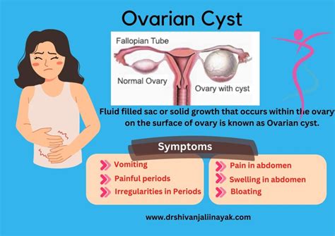Ruptured Ovarian Cyst Symptoms