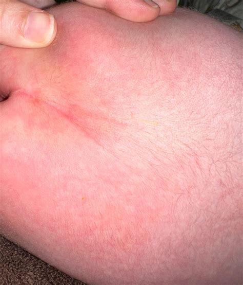 Sacral Dimple In Newborn