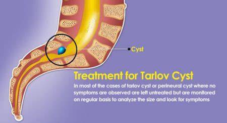 Sacral Tarlov Cyst Treatment