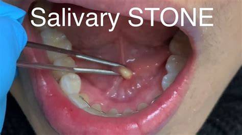 Salivary Gland Stone