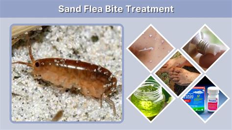 Sand Flea Bites Treatment