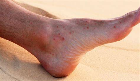 Sand Fleas Bites On Humans