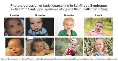 Sanfilippo Syndrome Symptoms
