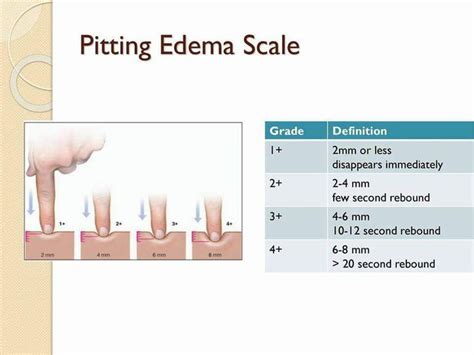 Scale For Edema