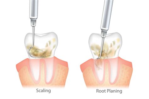 Scaling Root Planing