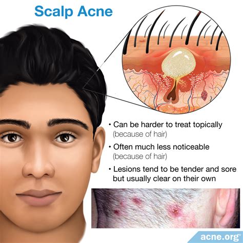 Scalp Acne Treatment