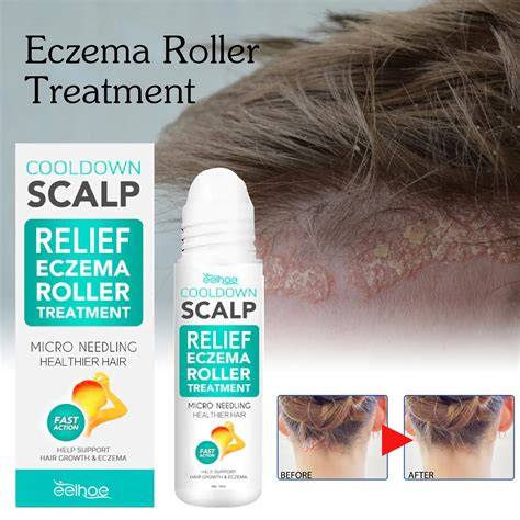 Scalp Eczema Treatment