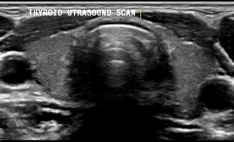 Scan Thyroid Gland