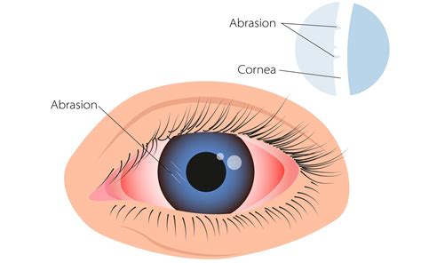 Scratch On Eye