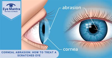 Scratched Eye Treatment