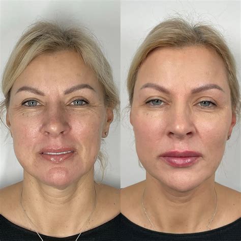 Sculptra Before And After