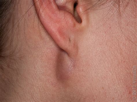 Sebaceous Cyst Back Of Ear
