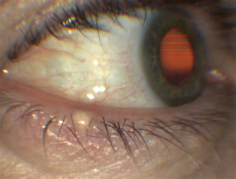 Sebaceous Cyst Eyelid