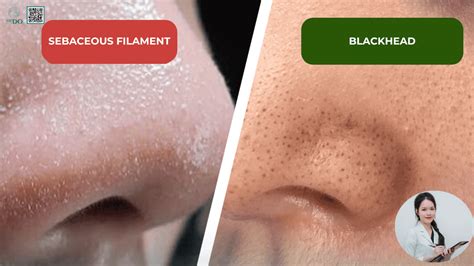 Sebaceous Filament Vs Blackhead
