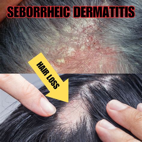 Seborrheic Dermatitis Hair Loss
