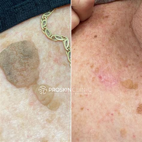 Seborrheic Keratosis Treatments