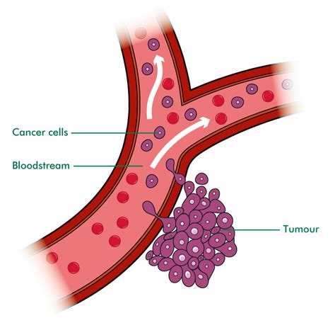 Secondary Liver Cancer