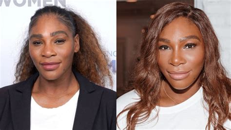 Serena Williams Face Surgery