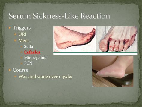 Serum Sickness Like Reaction
